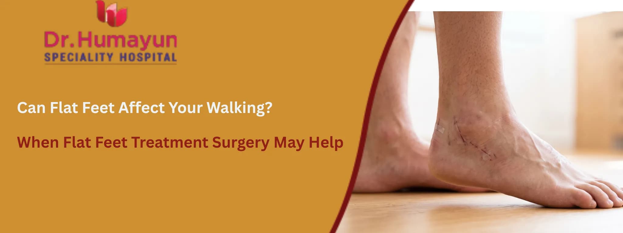 Can Flat Feet Affect Your Walking? When Flat Feet Treatment Surgery May Help, humayun hospital, chennai