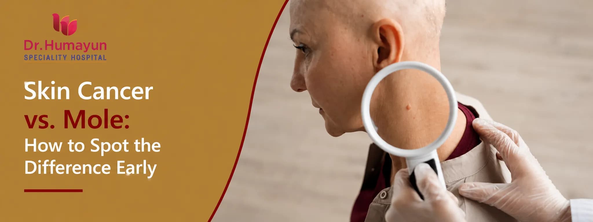Skin Cancer vs. Mole: How to Spot the Difference Early, Humayun Hospital, Chennai
