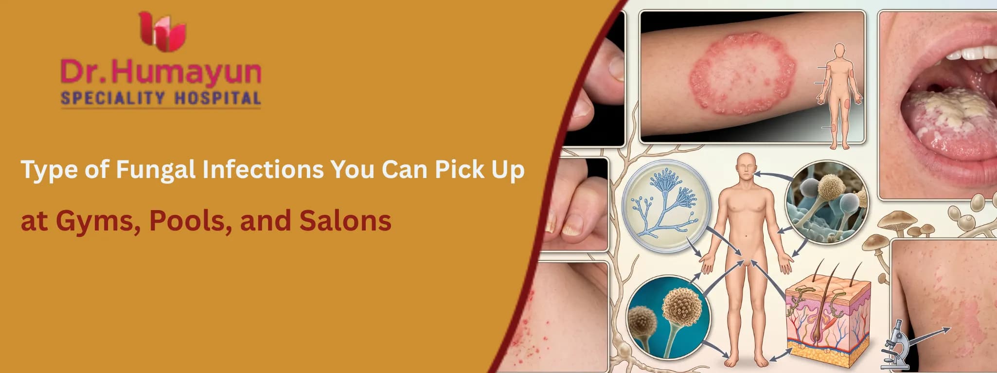 Type of Fungal Infections You Can Pick Up at Gyms, Pools, and Salons, humayun hospital, chennai
