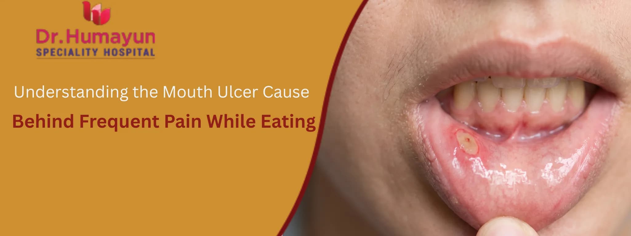 Understanding the Mouth Ulcer Cause Behind Frequent Pain While Eating at humayun hospital chennai